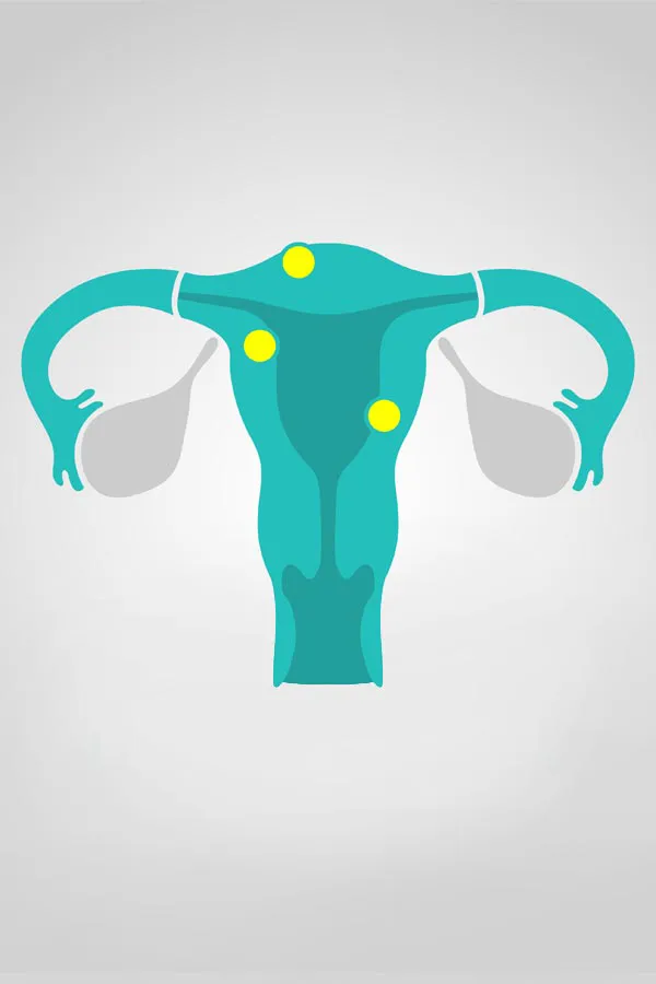 Vancouver-Fibroids-Treatment Vancouver Fibroids Treatment
