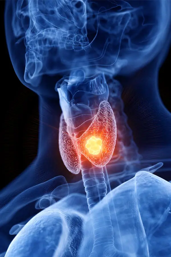 Vancouver-Thyroid-Imbalance-Treatment Vancouver Thyroid Treatment